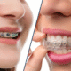Dental Braces in Gandhinagar: Metal, Ceramic, or Invisalign — Which Is Right for You?