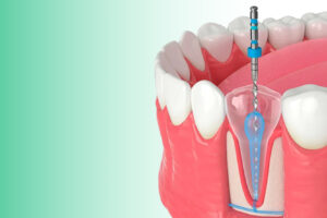 How Long Does a Root Canal Actually Take And Does It Really Hurt?