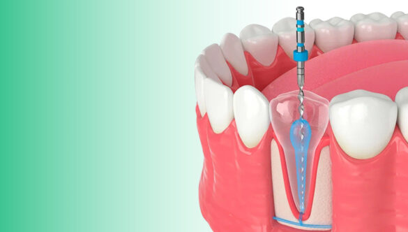 How Long Does a Root Canal Actually Take And Does It Really Hurt?