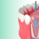 How Long Does a Root Canal Actually Take And Does It Really Hurt?