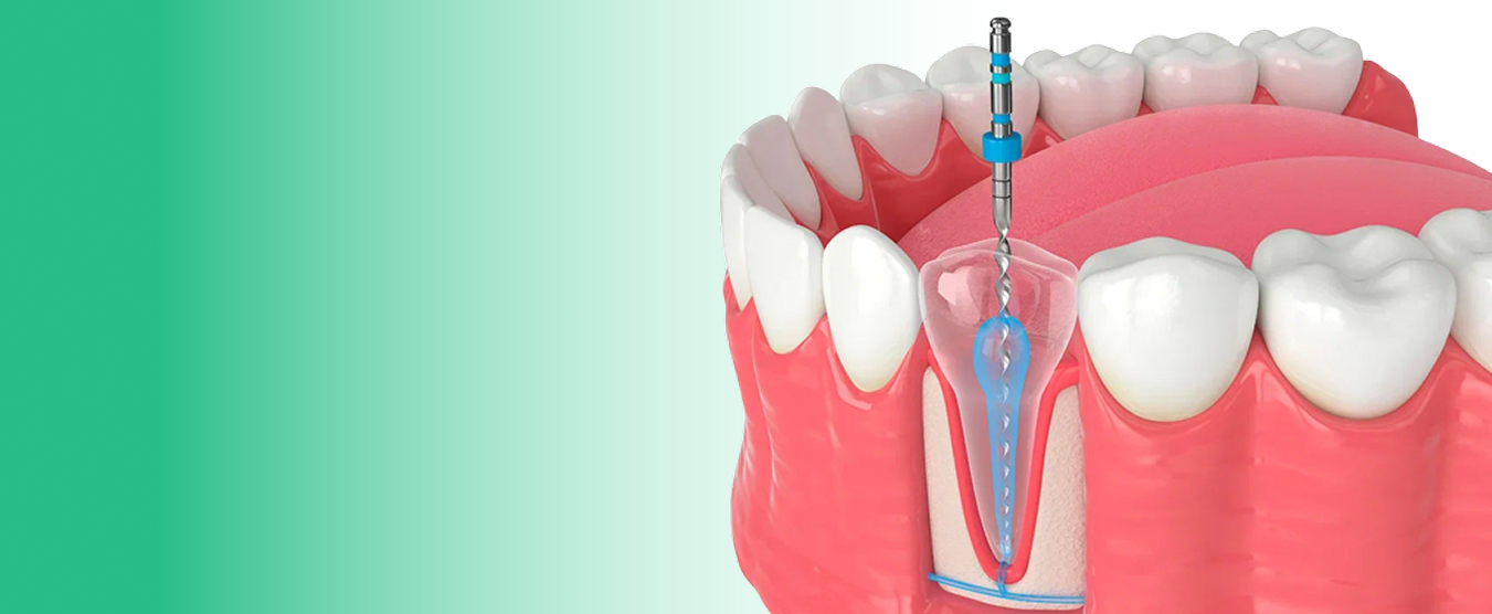 How Long Does a Root Canal Actually Take And Does It Really Hurt?