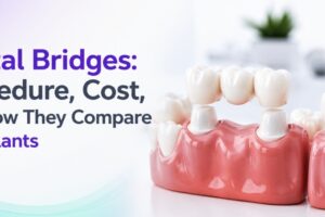 Dental Bridges: Procedure, Cost, and How They Compare to Implants
