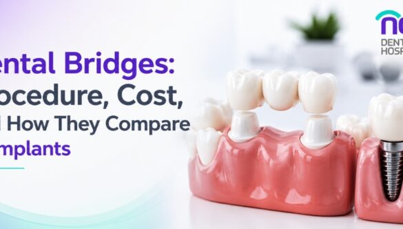 Dental Bridges: Procedure, Cost, and How They Compare to Implants