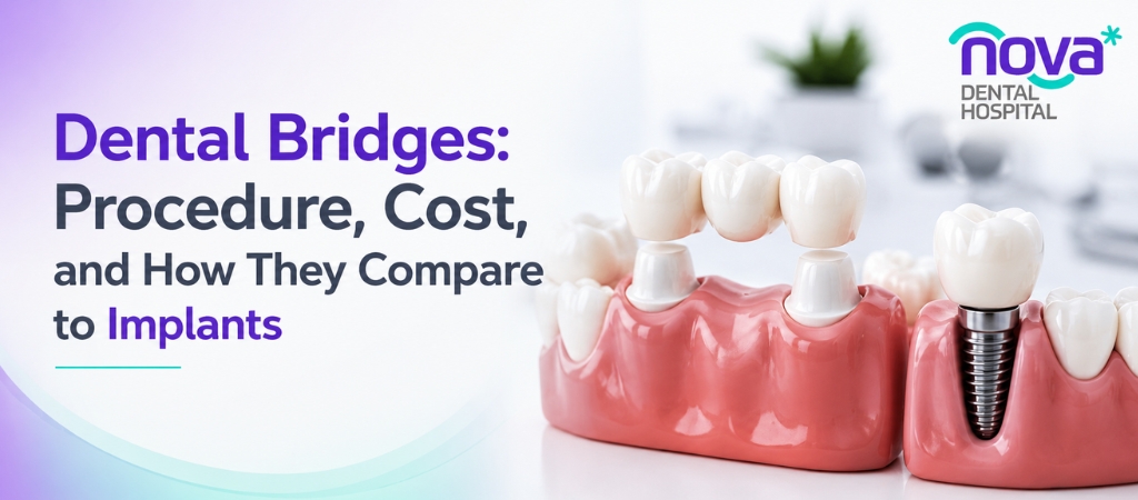Dental Bridges: Procedure, Cost, and How They Compare to Implants