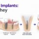 Mini Dental Implants: Who Are They Right For?