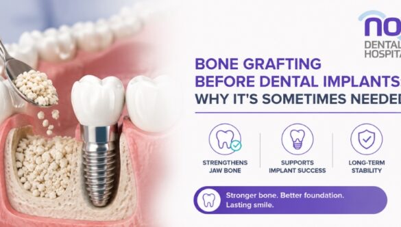Bone Grafting Before Dental Implants: Why It’s Sometimes Needed