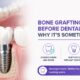Bone Grafting Before Dental Implants: Why It’s Sometimes Needed