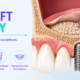 Sinus Lift Surgery: What It Is and Why Upper Implants Sometimes Need It