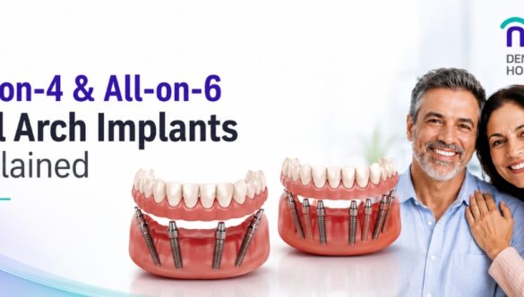 All-on-4 & All-on-6 Full Arch Implants Explained