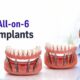All-on-4 & All-on-6 Full Arch Implants Explained