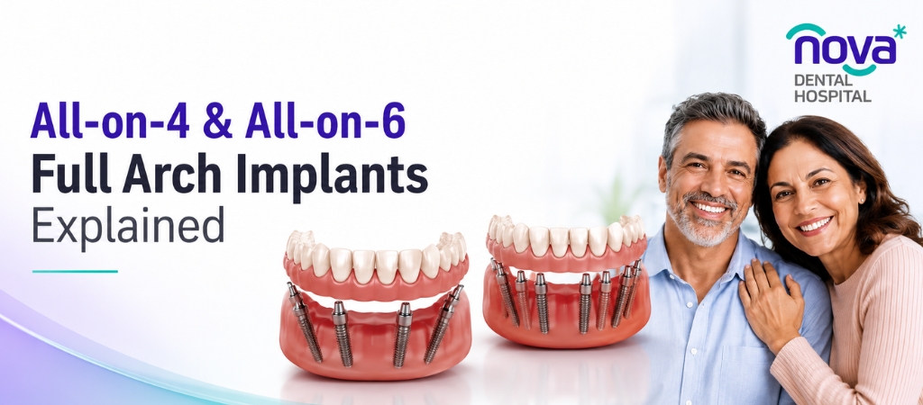 All-on-4 & All-on-6 Full Arch Implants Explained