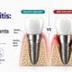 Peri-Implantitis: How to Protect Your Dental Implants for Life