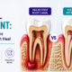 Root Canal Retreatment: What Happens When the First Root Canal Doesn’t Heal