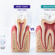 Front Tooth vs Molar Root Canal: Why the Procedure Differs