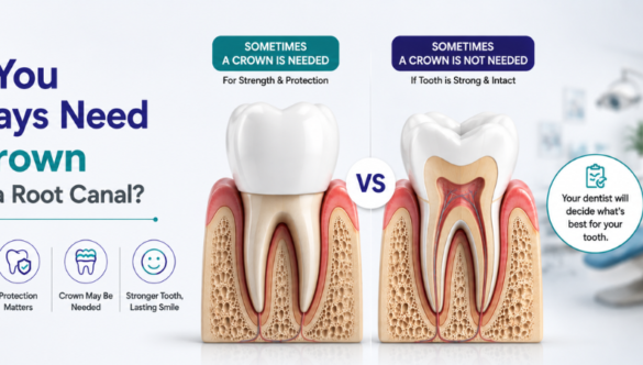 Do You Always Need a Crown After a Root Canal?