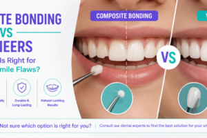 Composite Bonding vs Veneers: Which Is Right for Minor Smile Flaws?