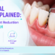 Periodontal Surgery Explained: Flap Surgery, Pocket Reduction & What to Expect
